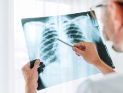 Manfaat dan Fakta tentang Vaksin BCG untuk Pencegahan Tuberkulosis