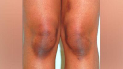 Tips Ampuh Menghilangkan Kulit Siku dan Lutut Hitam
