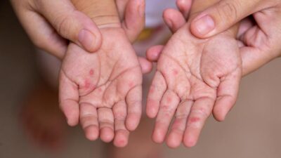 Syarat Kejadian Luar Biasa Penyakit Menular di Daerah: Panduan Terbaik