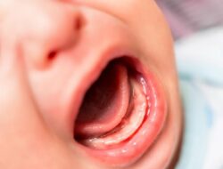 Laporan Polisi: Balita Diduga Digigit di Daycare
